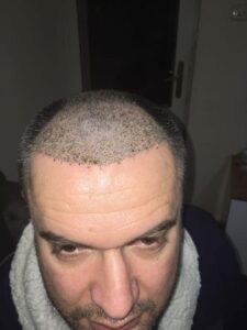 השתלת שיער במצב 2 בסולם נורווד - לאחר מספר חודשים