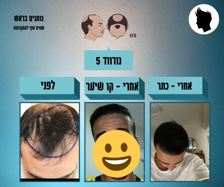 גידול שיער עם טיפול חדשני ב-PRP.