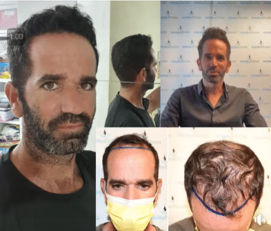 סיפורי הצלחה של ניתוח השתלת השיער