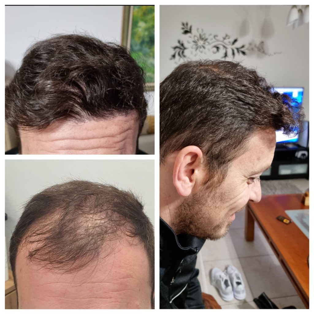 שינוי משמעותי בצמיחת השיער לאחר שתל שיער