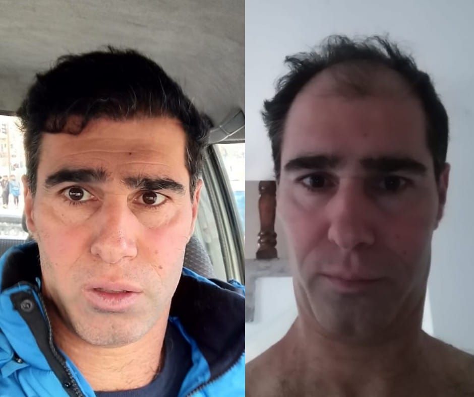 השינוי לאחר ניתוח שתל השיער