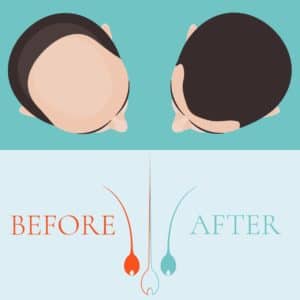 כמה זמן לוקח לשיער לצמוח לאחר השתלת שיער