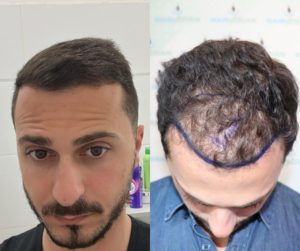 עבודת עיבוי ויצירת קו שיער חדש - השתלת שיער בטורקיה