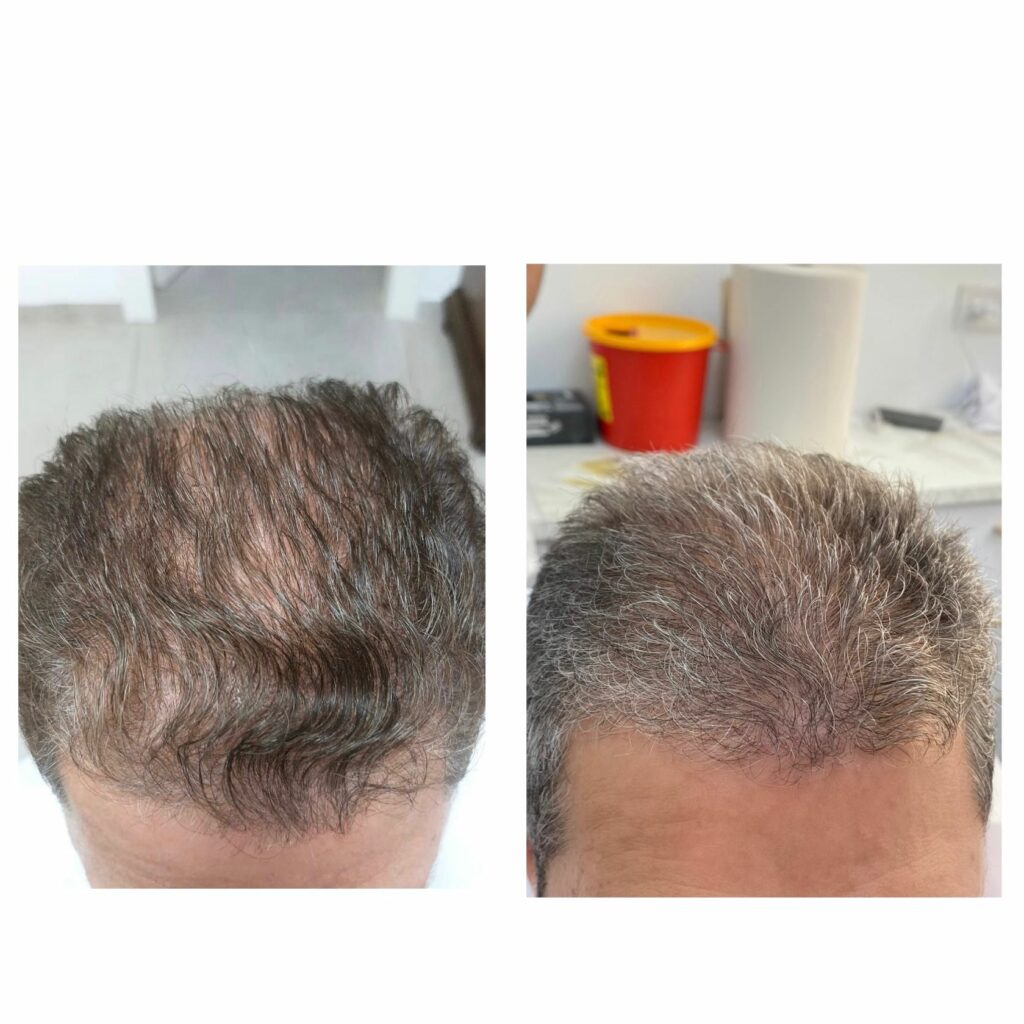 שינוי משמעותי בנפח השיער לאחר ניתוח טרנספלנט השיער.