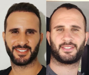 השתלת שיער בישראל מחירים