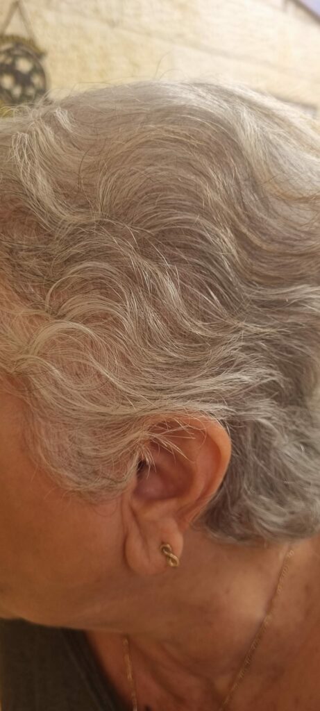 מימי ילוביץ בשיתוף כנה ורגיש על התהליך העוצמתי שחוותה - השתלת שיער לנשים6