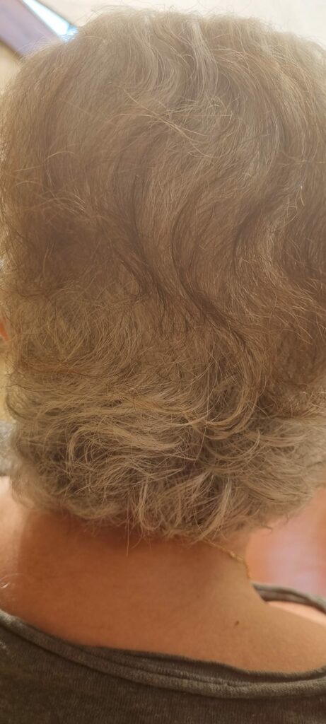מימי ילוביץ בשיתוף כנה ורגיש על התהליך העוצמתי שחוותה - השתלת שיער לנשים7