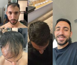 איש עם הצלחה בהשתלת שיער המראה את השינוי שלפני ואחרי השיער